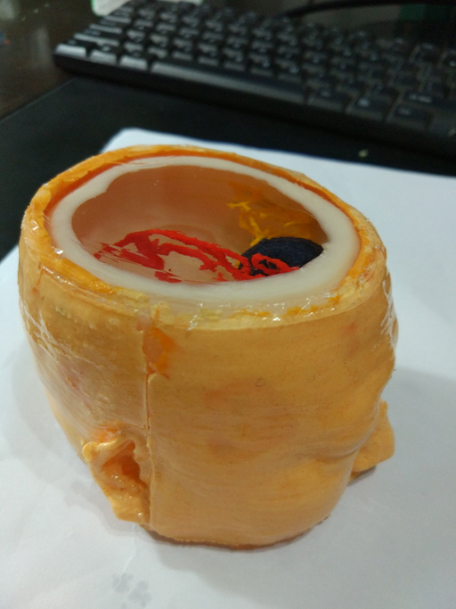 颅内肿瘤